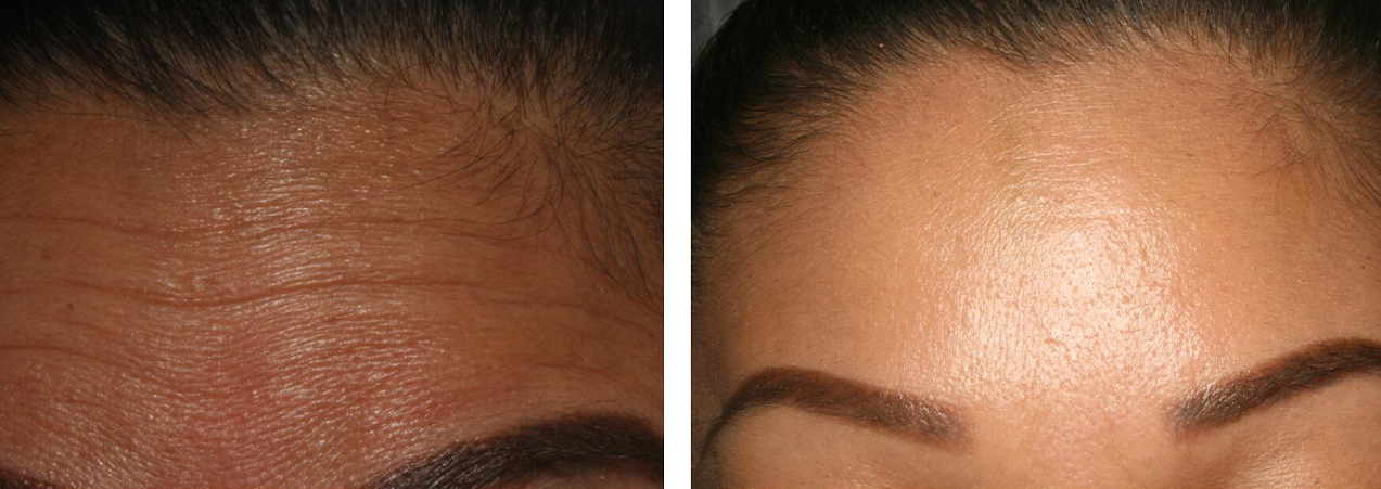 Closeup of patient's forehead before and after Botox and Juvederm treatment
