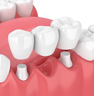 illustration of traditional dental bridge 