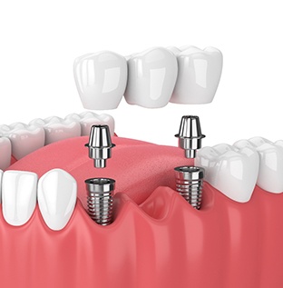 illustration of implant dental bridge 