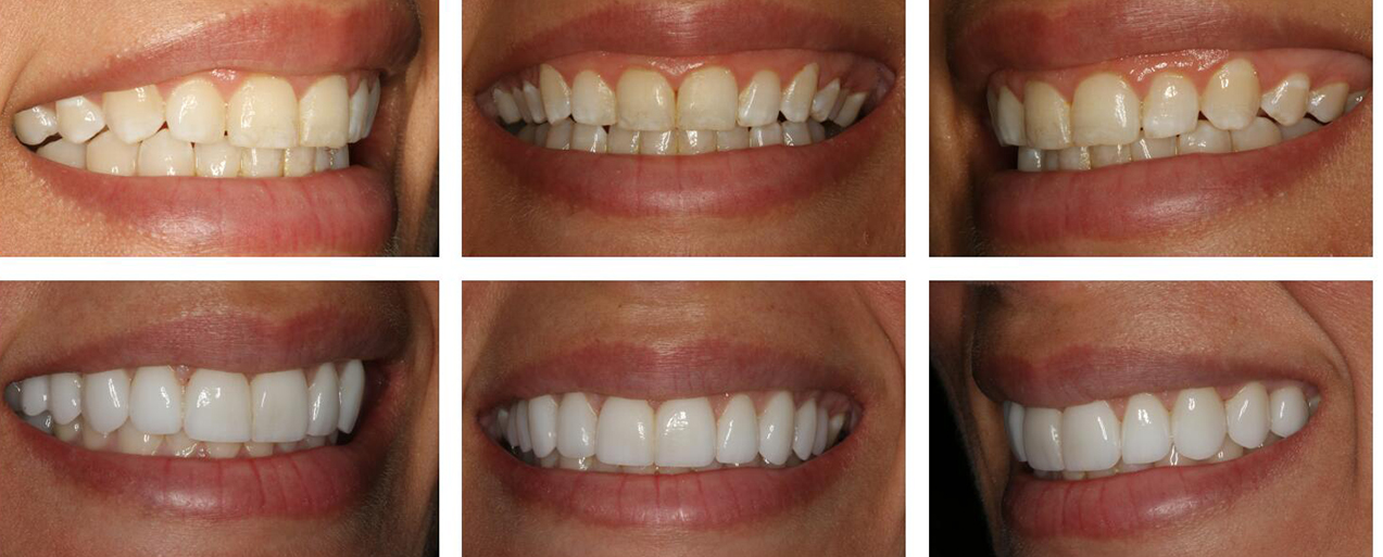 Smile from three angles before and after gum recontouring