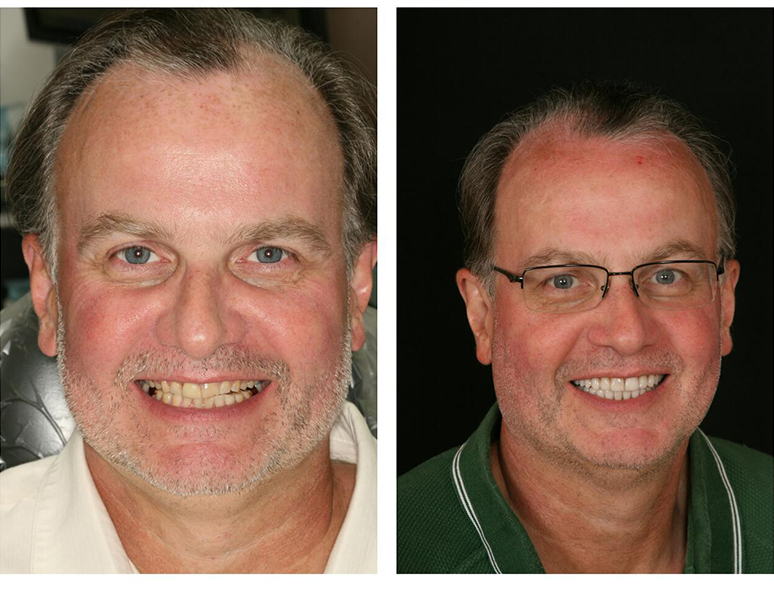 Man sharing smile before and after smile makeover