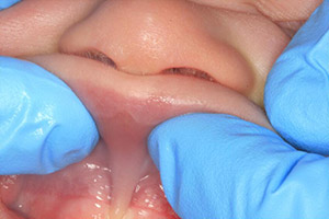 Smile before treatment for lip tie