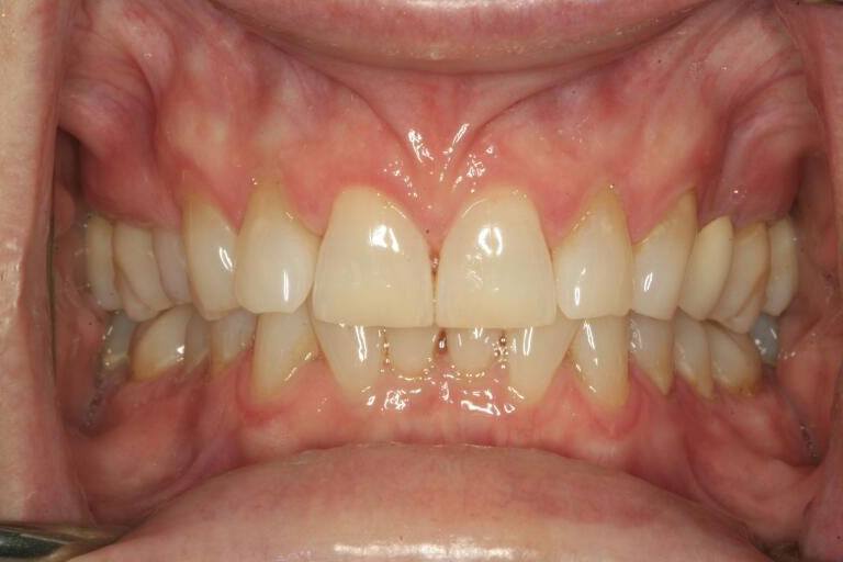 Smile with excess tissue before frenectomy for lip tie