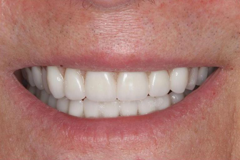 Smile restored by full dentures