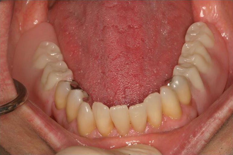 Smile restored with stable dental implant supported partial denture