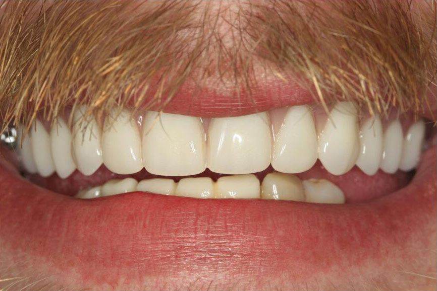 Smile with several missing top teeth replaced by partial denture