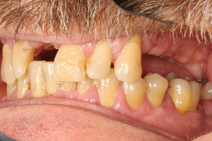Smile extensive tooth loss on the upper arch