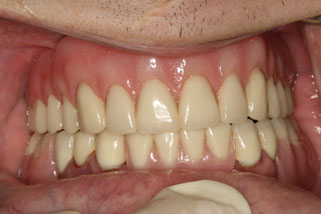 Closeup of smile fully restorated by new denture