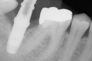 X-ray of dental implant in place before dental crown placement
