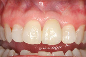 Closeup of smile with dental implant supported dental crown