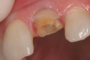 Closeup of smile with severely decayed tooth
