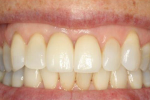 Smile with missing and damaged teeth replaced by dental implant supported dental crowns