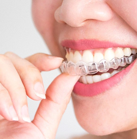 Smiling woman putting clear aligner on top teeth
