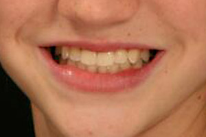 Closeup of smile after underbite is corrected by orthodontic treatment