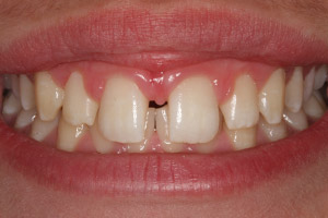 Closeup of patient's smile with gaps between teeth