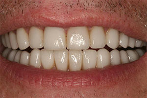 Closeup of smile with dental crowns repairing dental damage and wear