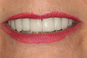 Closeup of bright healthy smile after dental crown treatment