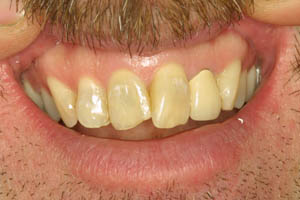 Damaged and overlapping front teeth before dental crown restoration