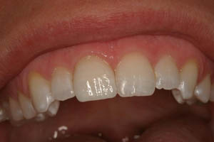 Closeup of smile with tooth repaired by dental crown