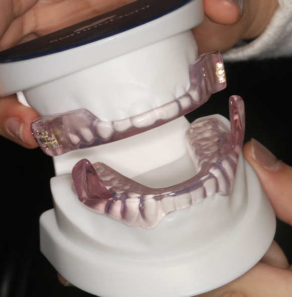Model smile with small oral appliance for sleep apnea