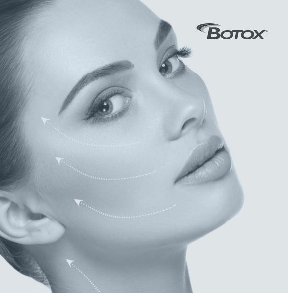Woman's face with areas for Botox to address T M J dysfunction highlighted