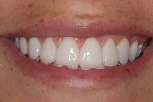 Closeup of perfect smile with porcelain veneers