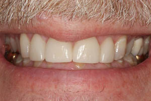 Closeup of smile with gaps between front teeth closed with porcelain veneers