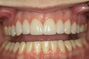 Closeup of dental patient's smile after porcelain veneer treatment