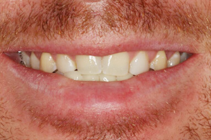 Closeup of discolored smile before porcelain veneers