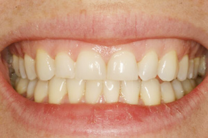 Closeup of woman's smile with short top teeth