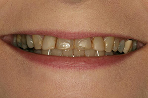 Severely disolored smile before porcelain veneers
