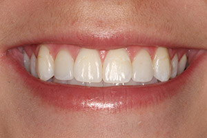Closeup of young woman's smile perfected by porcelain veneers