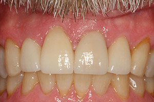 Closeup of smile porcelain veneers perfecting the look of the top front two teeth