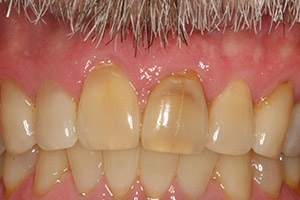 Closeup of smile with top front two teeth darkly discolored