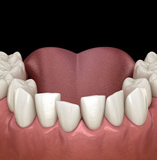 Illustration of crooked teeth