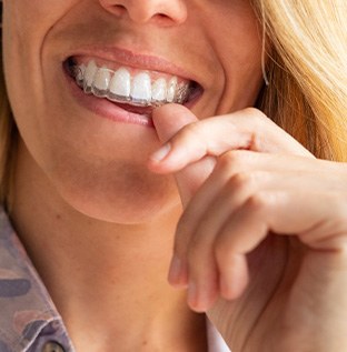 Nose-to-neck view of woman placing Invisalign over upper arch