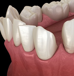 Illustration of gapped teeth