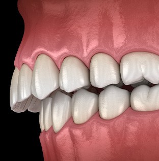 Illustration of an overbite