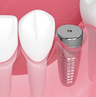 Illustration of dental implant in Kittanning, PA during osseointegration