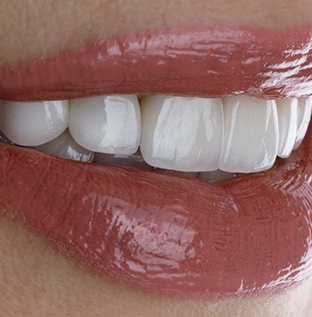 Close-up of woman’s smile with dental implants in Kittanning, PA