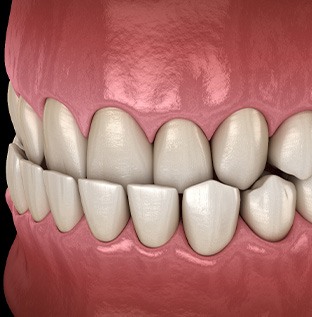 Illustration of an underbite