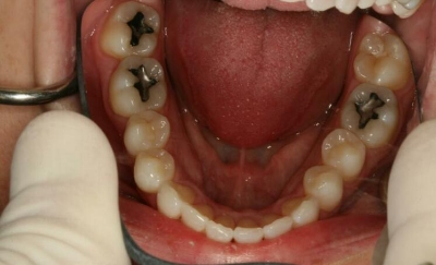Smile with properly aligned bottom teeth after orthodontic treatment