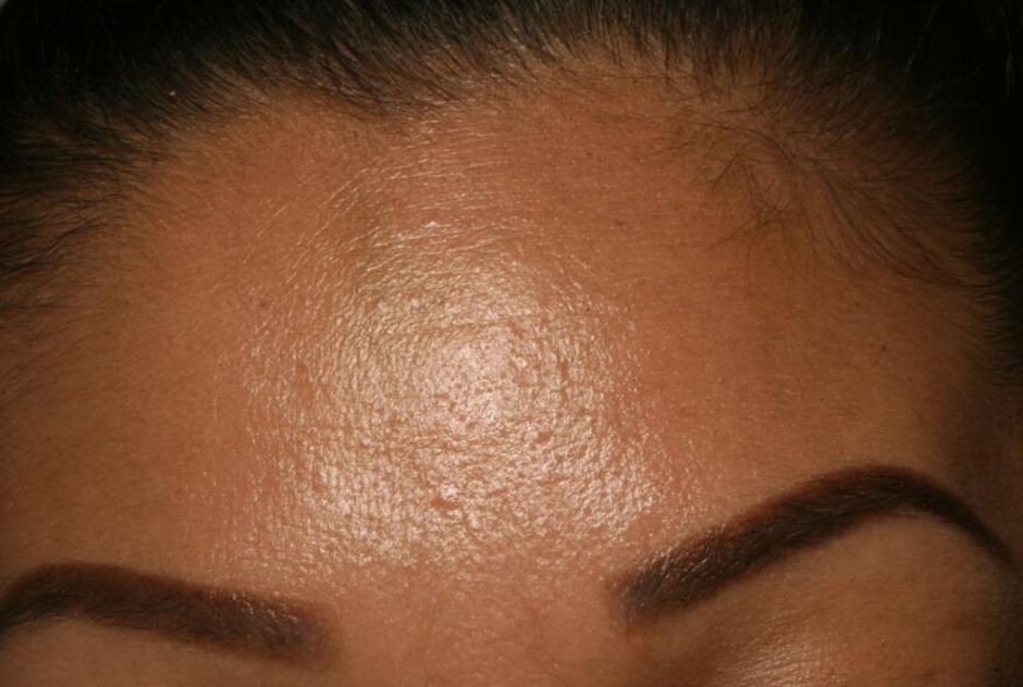 Closeup of smooth forehead after Botox injections