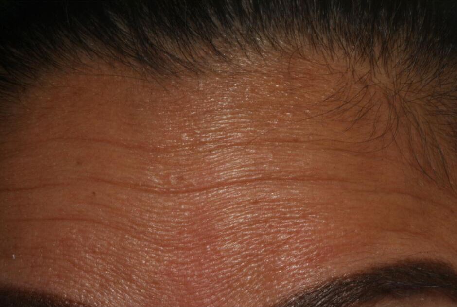 Closeup of forehead with deep wrinkles before Botox injections