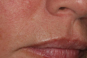 Closeup of mouth without wrinkles around upper lip after Botox