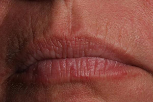 Closeup of mouth with wrinkles aournd upper lip before Botox