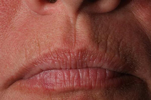 Patient with wrinkles around mouth before Botox
