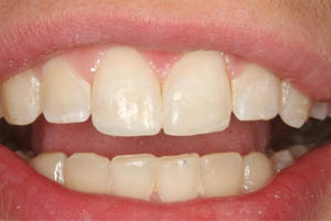 Closeup of smile with chipped tooth repaired with composite resin dental filling
