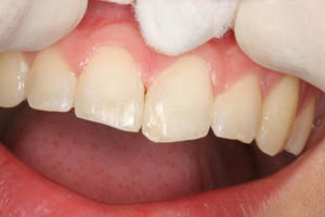 Closeup of smile with chipped front tooth