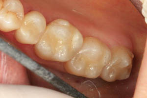 Smile with metal fillings replaced by tooth colored fillings